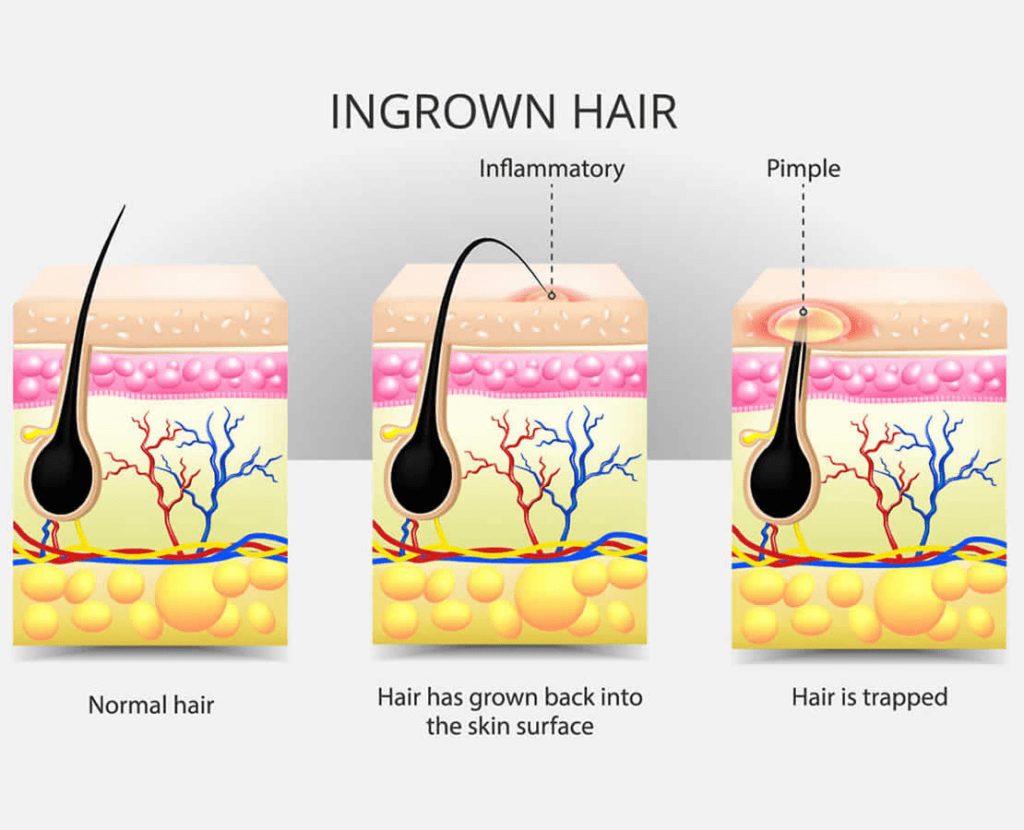 Ingrown Hair-Causes, Prevention & Treatment